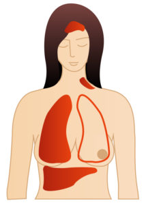 metastatic