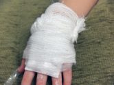Burn-Injuries-image