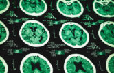 traumatic brain injury lawyer (TBI)