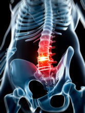 New York Herniated Disc Injury Attorneys