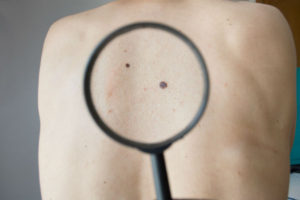 checking melanoma on back