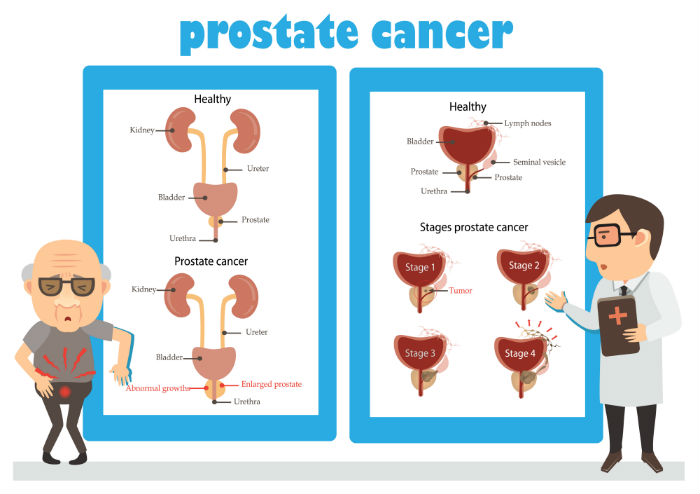 illustration-about-prostate-cancer