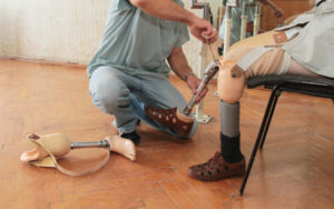 amputee with prosthetic leg