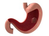 CGI of a stomach cancer