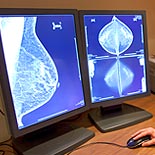 misdiagnosed breast cancer or delayed diagnosis of breast cancer can lead to additional suffering