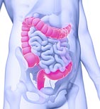 Colorectal Cancer Diagram