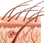 Diagram of Melanoma cancer